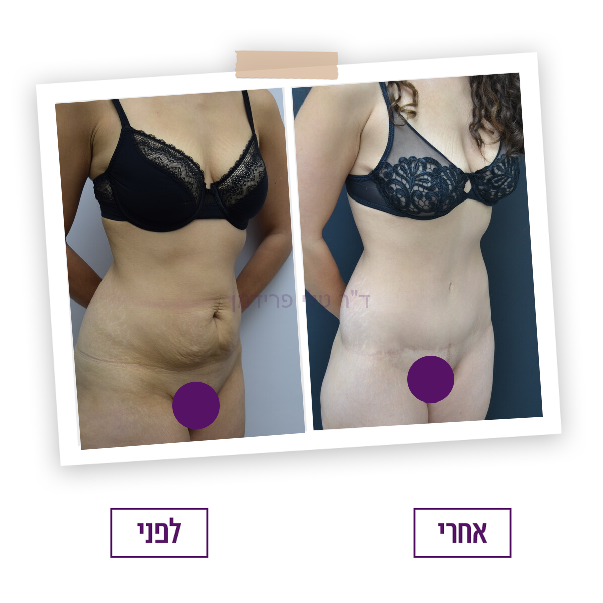 לפני ואחרי ניתוח מתיחת בטן היקפית - ד"ר טלי פרידמן